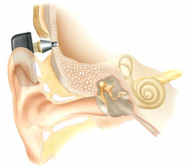 Улучшение характеристик слуховых аппаратов