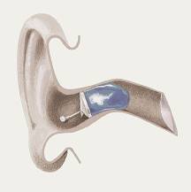 размещение внутриканального слухового аппарата